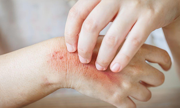 Aloe Vera and Fungal Infections: A Natural Approach