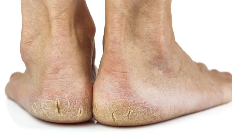Diabetes and Cracked Heels: Finding Relief From Foot Discomfort