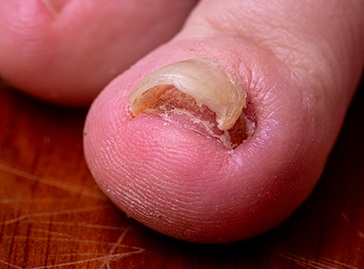  Loose Toenails. You Could Have Any Number of Conditions
