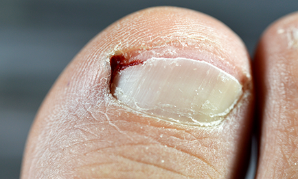 Poor Nail Health Can Cause Pain
