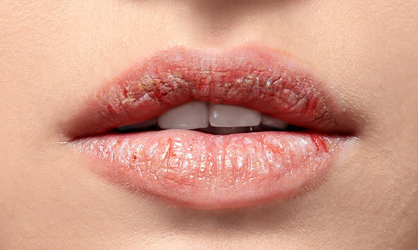 Lip Dryness? Heal Chapped Lips With the Right Lip Balm