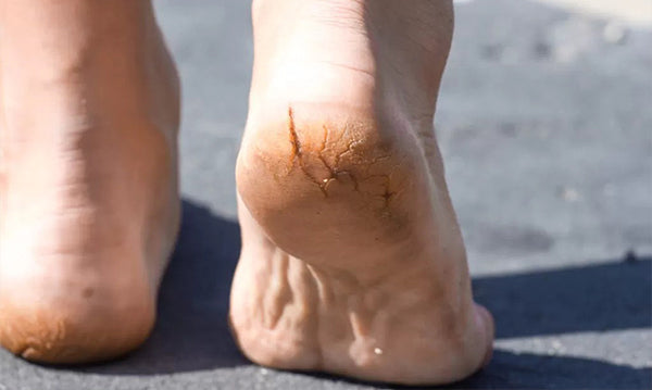 How Can I Treat Cracked Heels: A Guide to Soft, Healthy Heels
