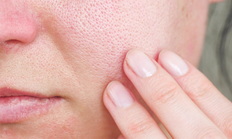 Does Aloe Vera Clog Pores?