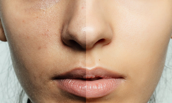 Is Aloe Vera Good for Oily Skin? Here's What to Know