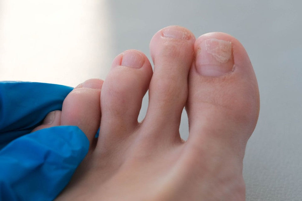 5 Common Reasons for Hard Toenails and How to Deal With Them
