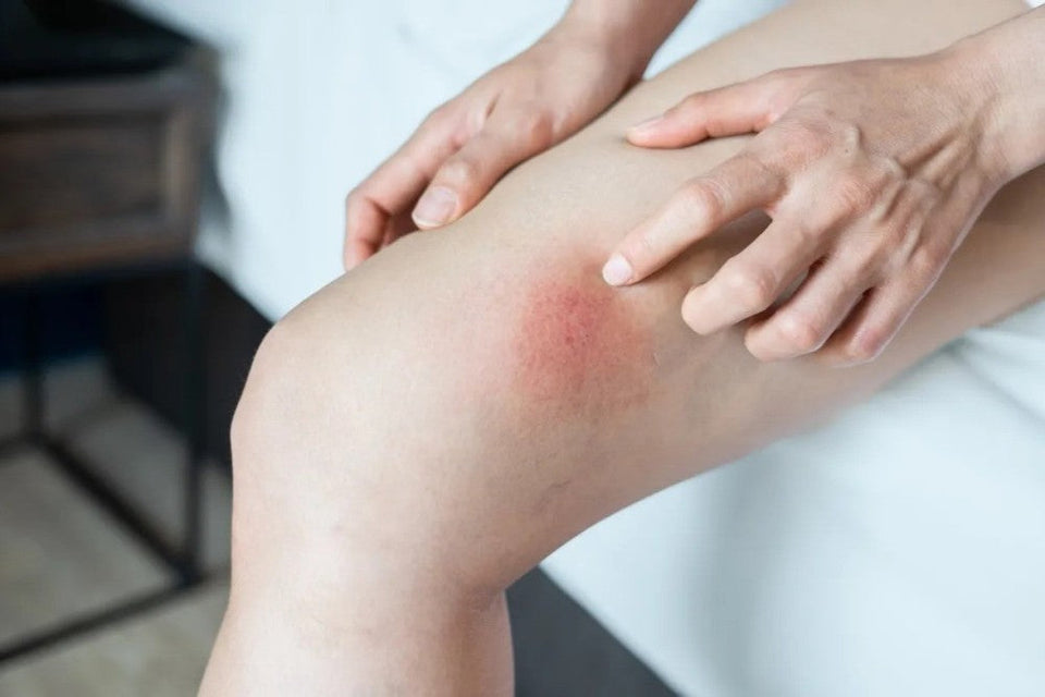 Preventing Chafing During Exercise: Tips for an Active Lifestyle