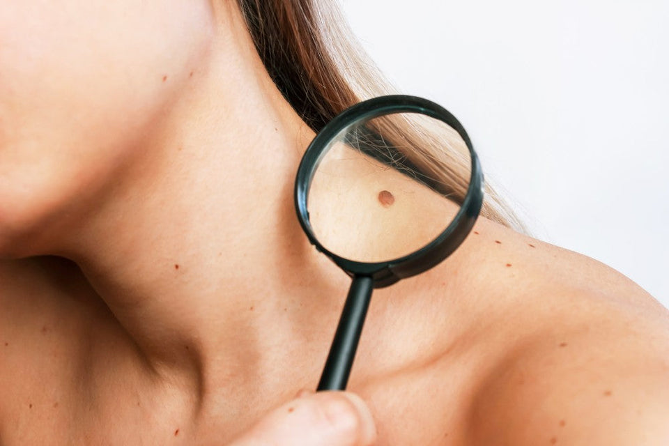 What Causes Skin Tags and Effective Ways to Treat Them