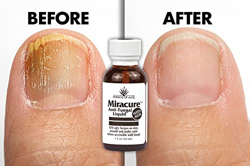 Miracure Anti-Fungal for Nails 